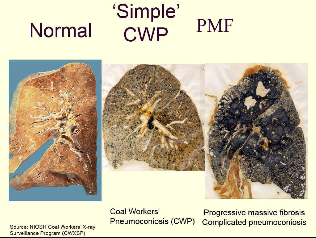 Black lung is and ongoing issue. Black lung is and ongoing issue.
